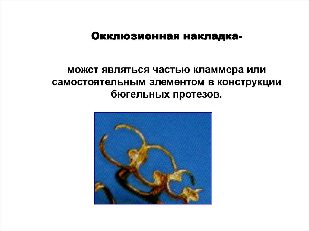 Окклюзионная накладка- может являться частью кламмера или самостоятельным элементом в конструкции бюгельных протезов.