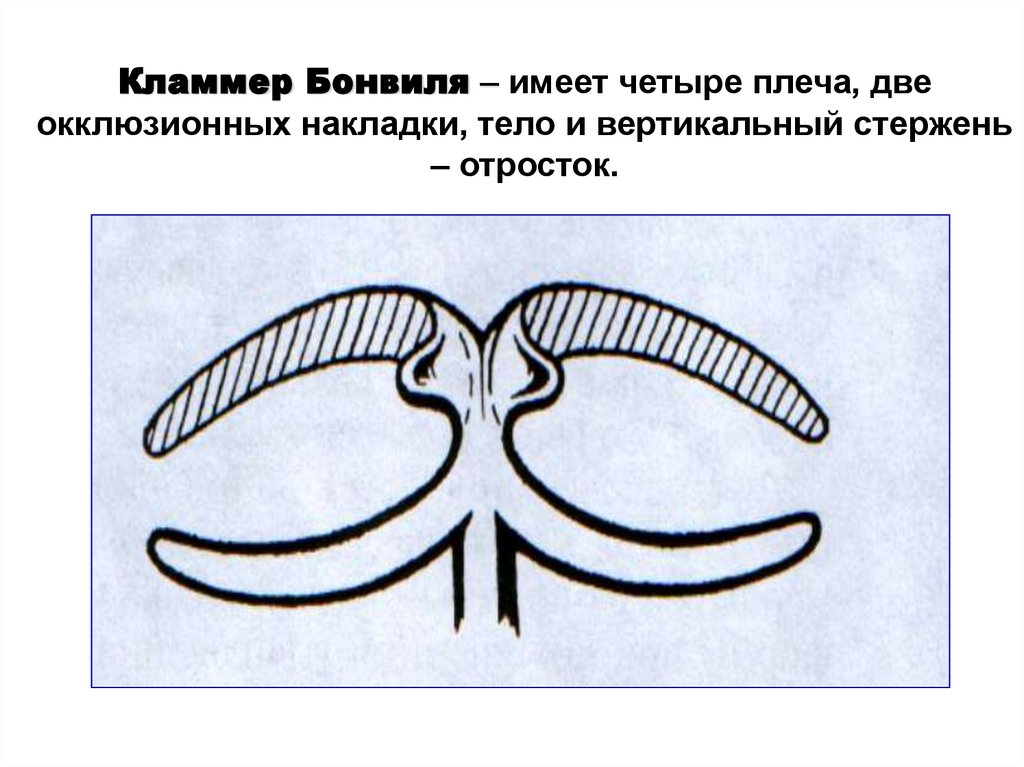 Кламмер Бонвиля – имеет четыре плеча, две окклюзионных накладки, тело и вертикальный стержень – отросток.