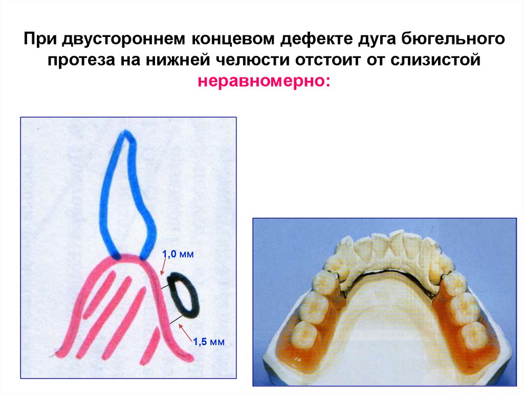 При двустороннем концевом дефекте дуга бюгельного протеза на нижней челюсти отстоит от слизистой неравномерно: