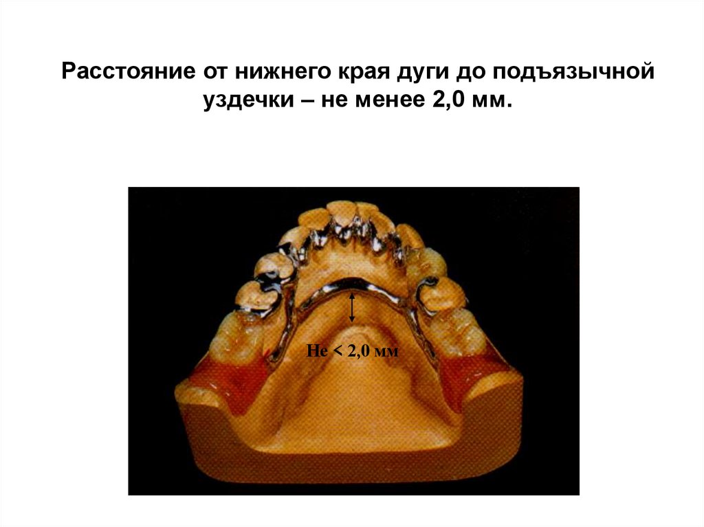 Расстояние от нижнего края дуги до подъязычной уздечки – не менее 2,0 мм.