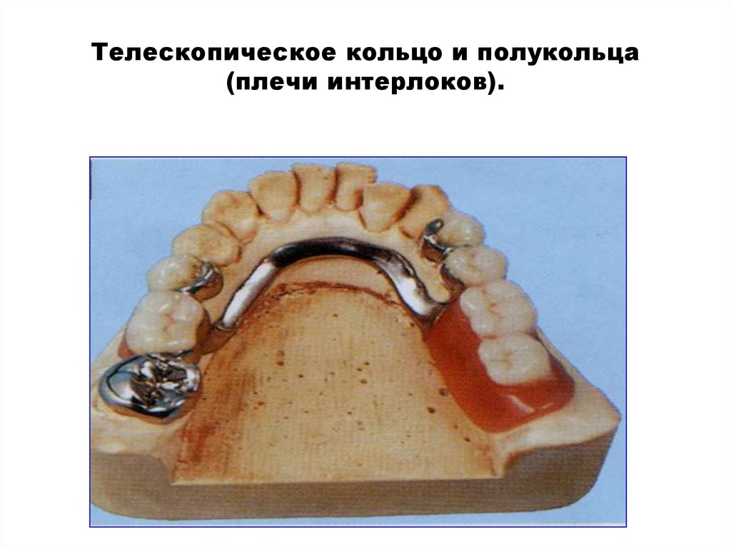 Телескопическое кольцо и полукольца (плечи интерлоков).