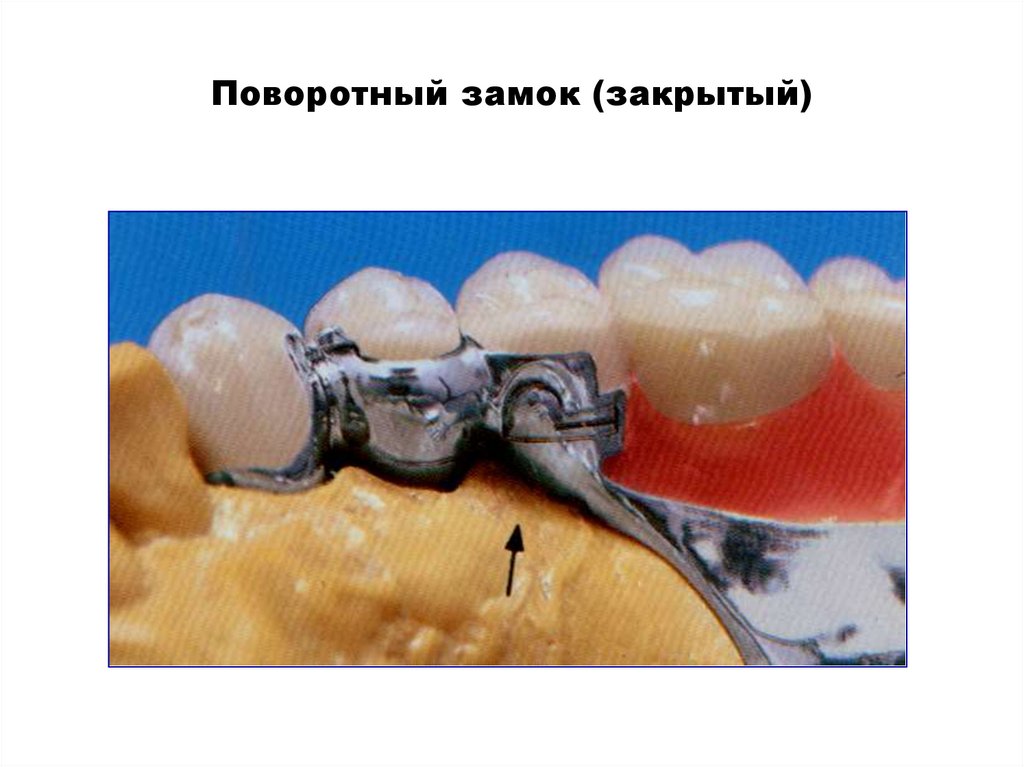 Поворотный замок (закрытый)
