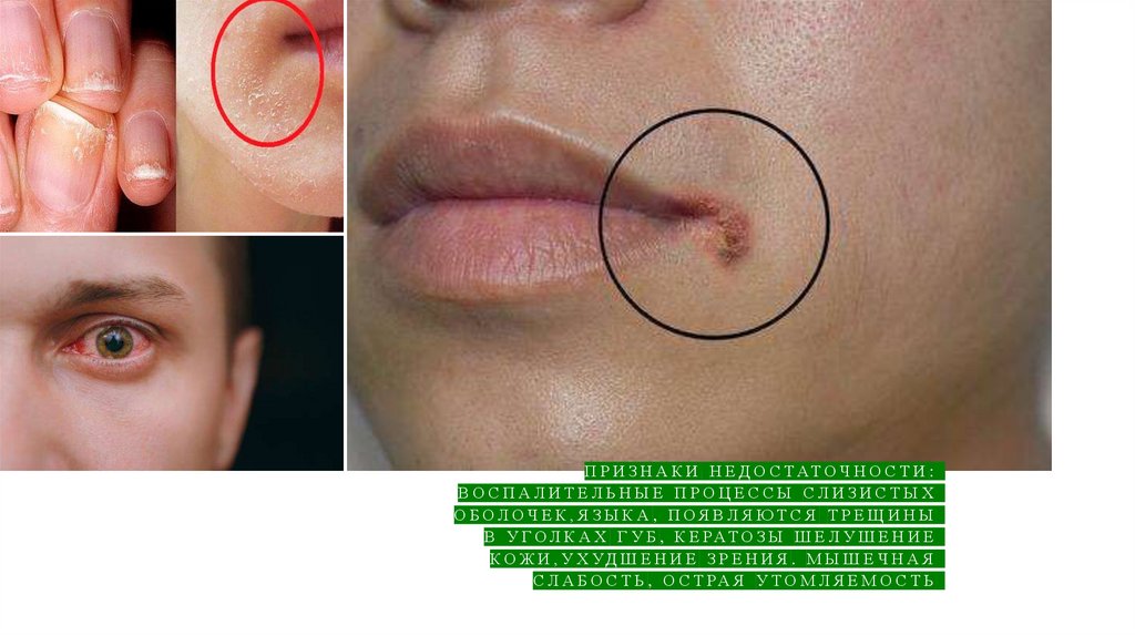 Признаки недостаточности: воспалительные процессы слизистых оболочек,языка, появляются трещины в уголках губ, кератозы