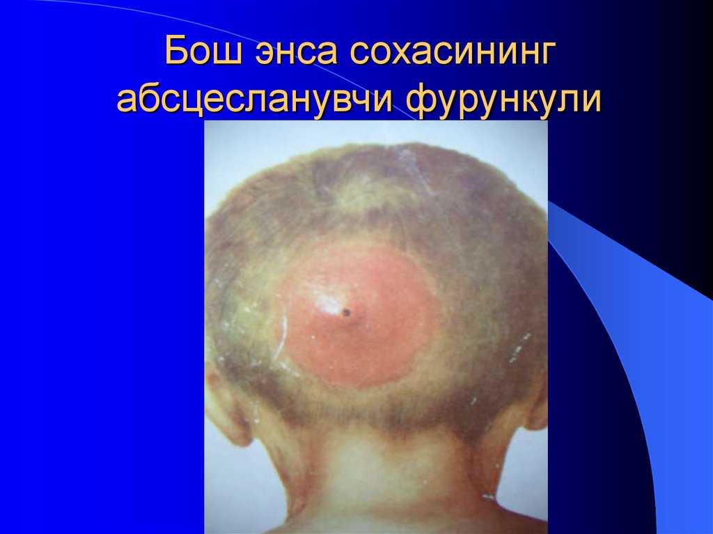 Бош энса сохасининг абсцесланувчи фурункули