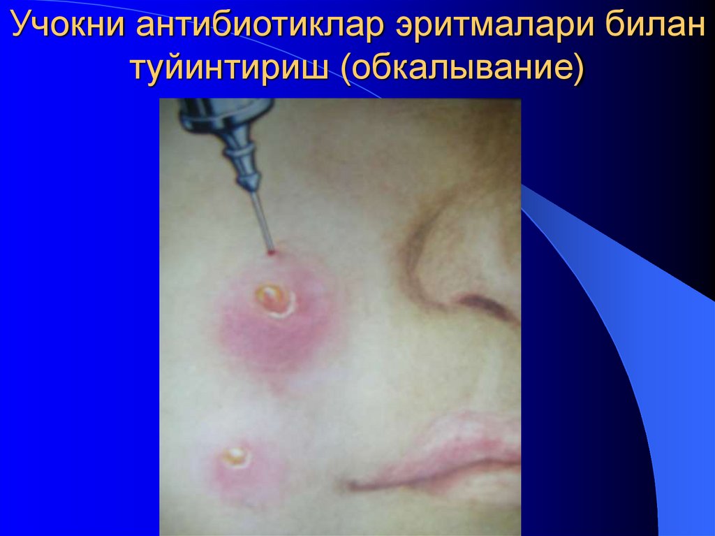 Учокни антибиотиклар эритмалари билан туйинтириш (обкалывание)