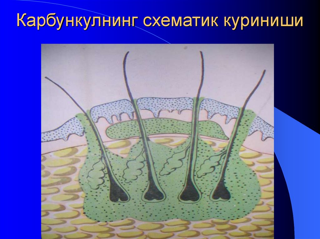 Карбункулнинг схематик куриниши