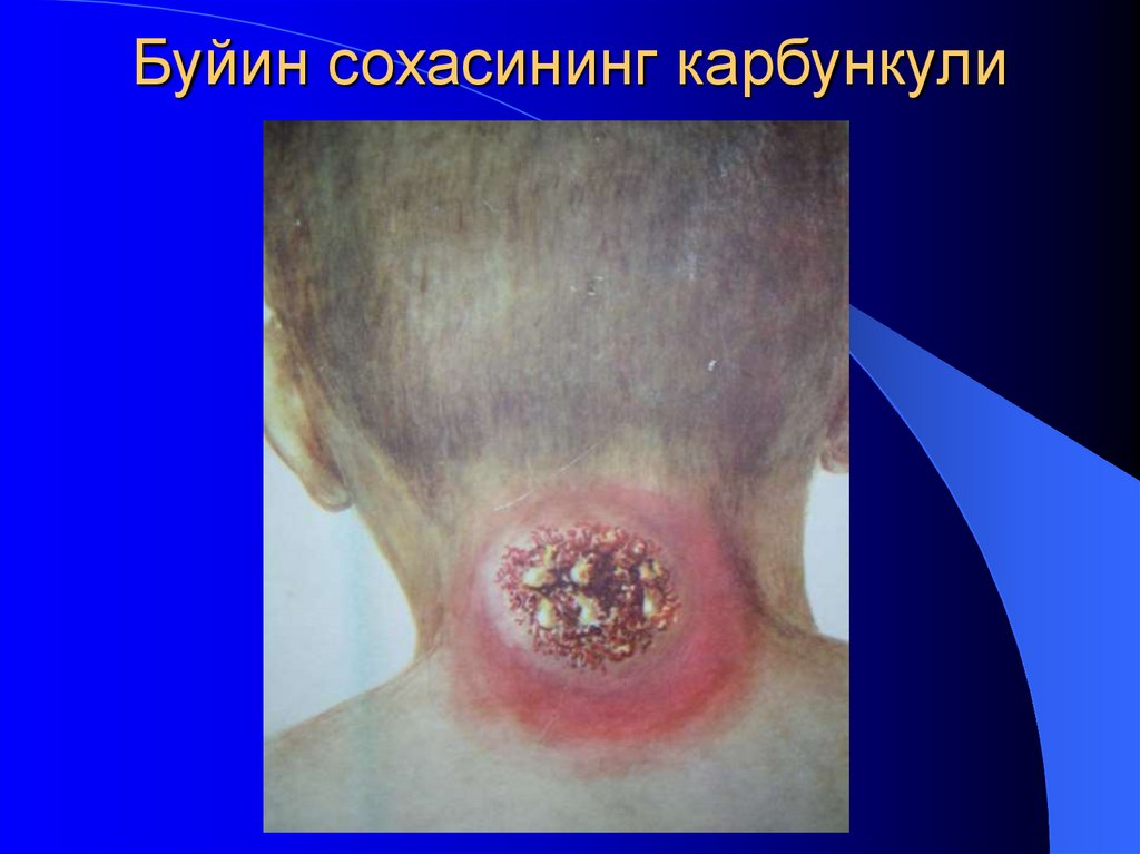 Буйин сохасининг карбункули