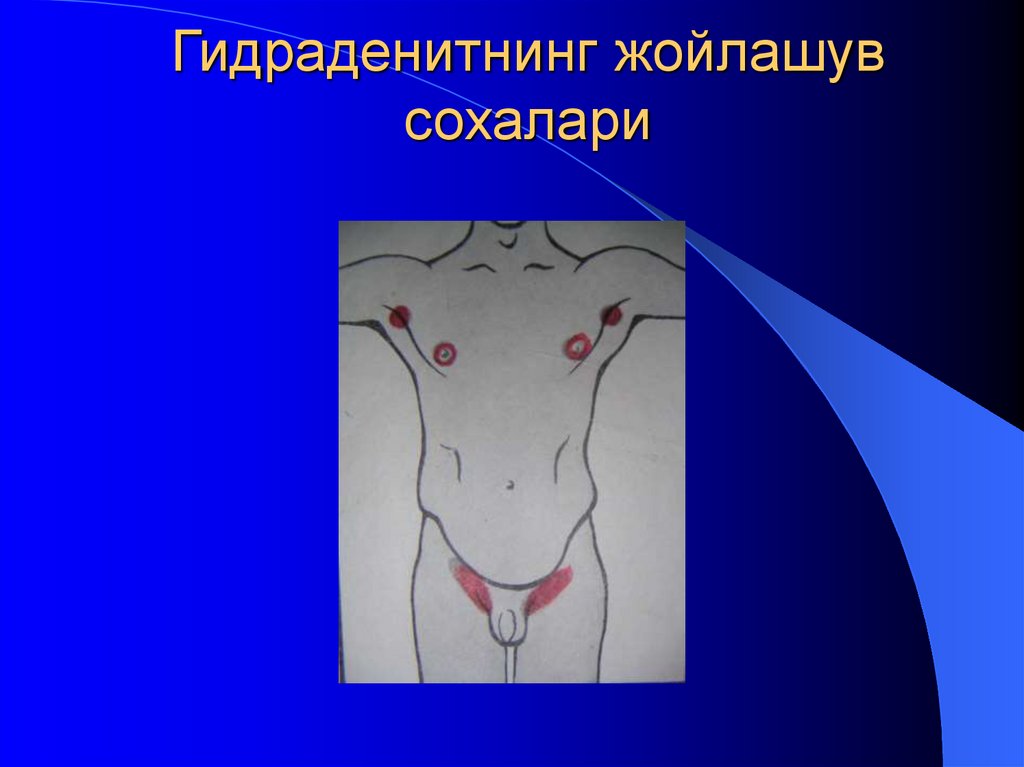 Гидраденитнинг жойлашув сохалари