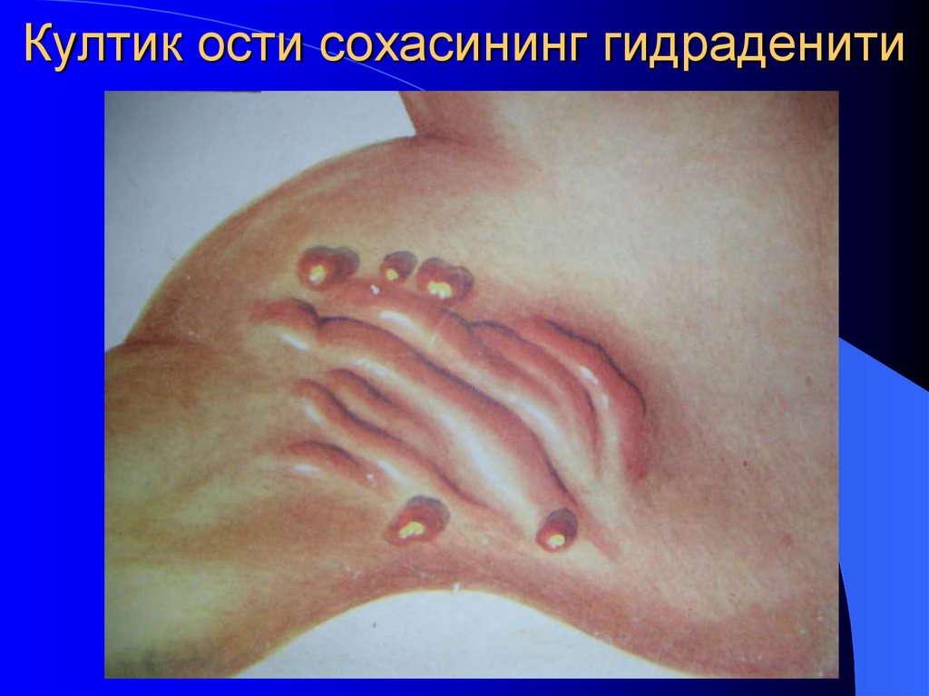 Култик ости сохасининг гидраденити