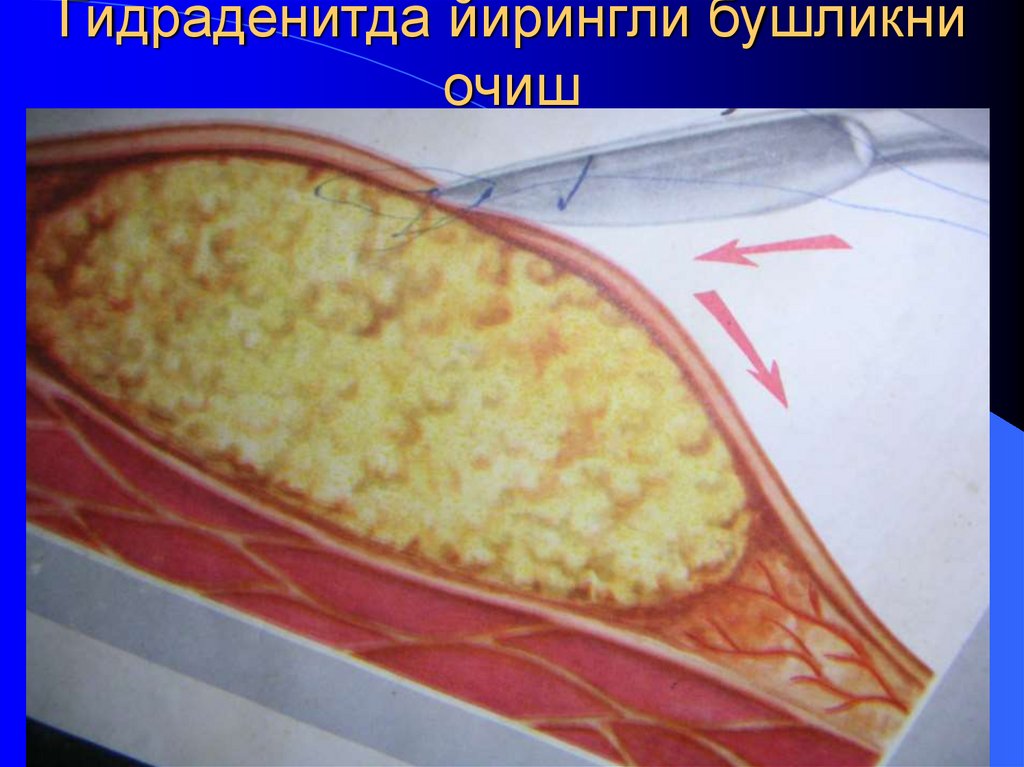 Гидраденитда йирингли бушликни очиш