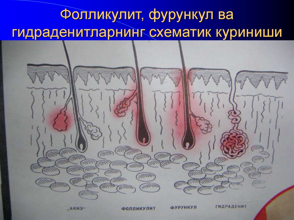 Фолликулит, фурункул ва гидраденитларнинг схематик куриниши