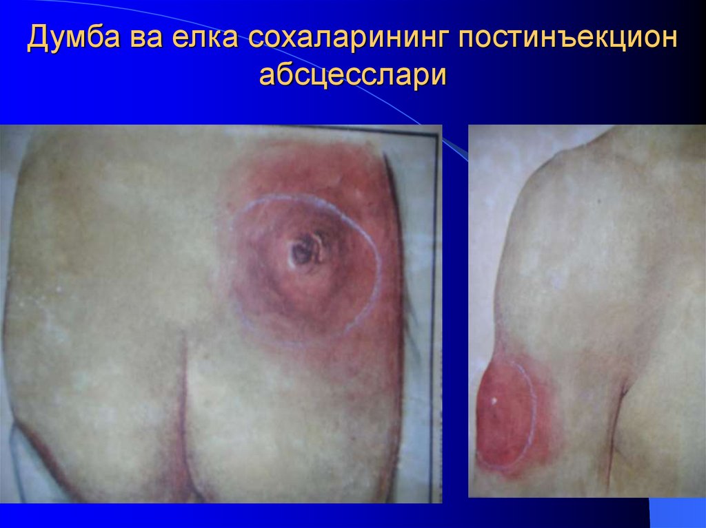 Думба ва елка сохаларининг постинъекцион абсцесслари