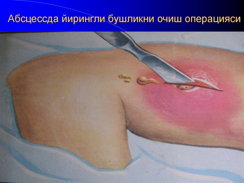 Абсцессда йирингли бушликни очиш операцияси