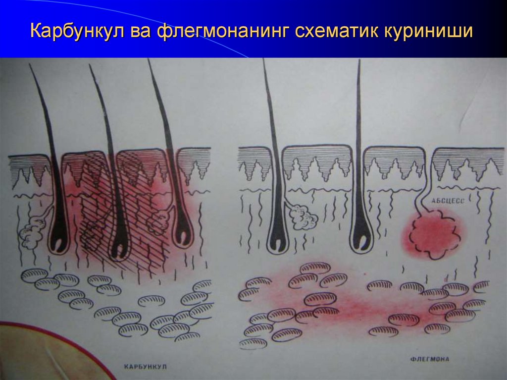 Карбункул ва флегмонанинг схематик куриниши