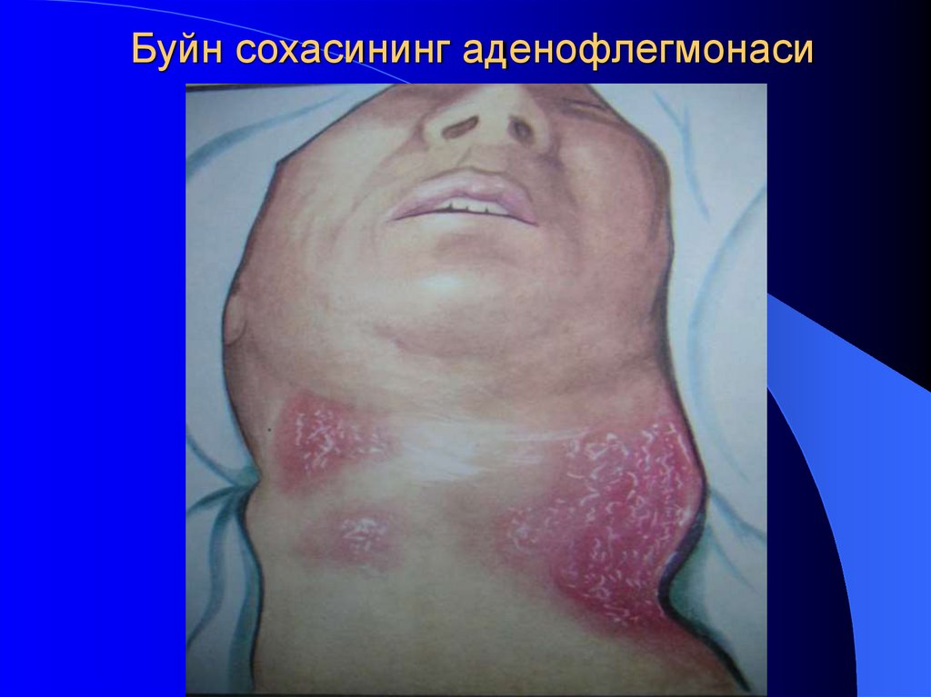 Буйн сохасининг аденофлегмонаси