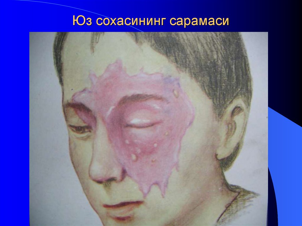 Юз сохасининг сарамаси