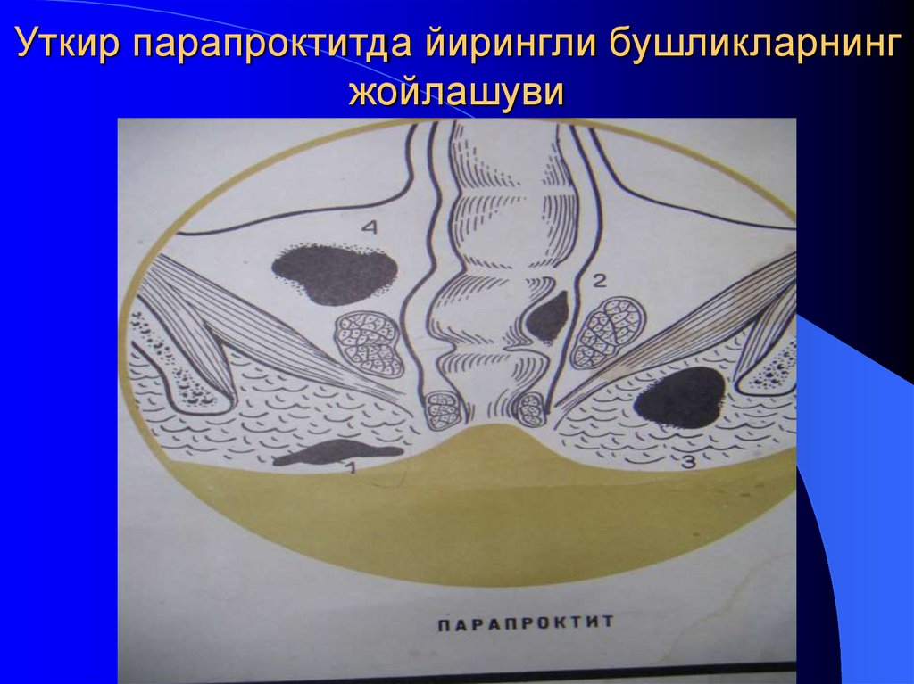 Уткир парапроктитда йирингли бушликларнинг жойлашуви