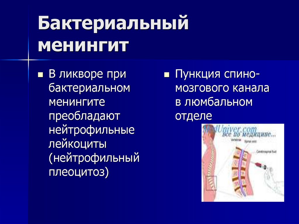 Бактериальный менингит