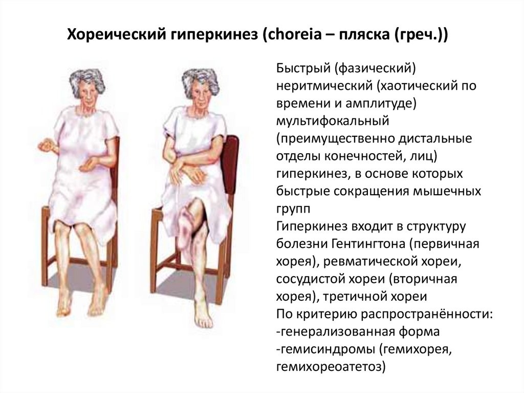 Хореический гиперкинез (choreia – пляска (греч.))