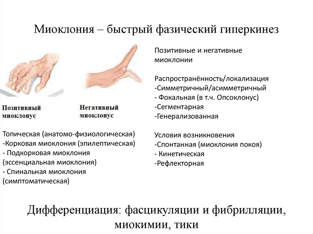 Миоклония – быстрый фазический гиперкинез