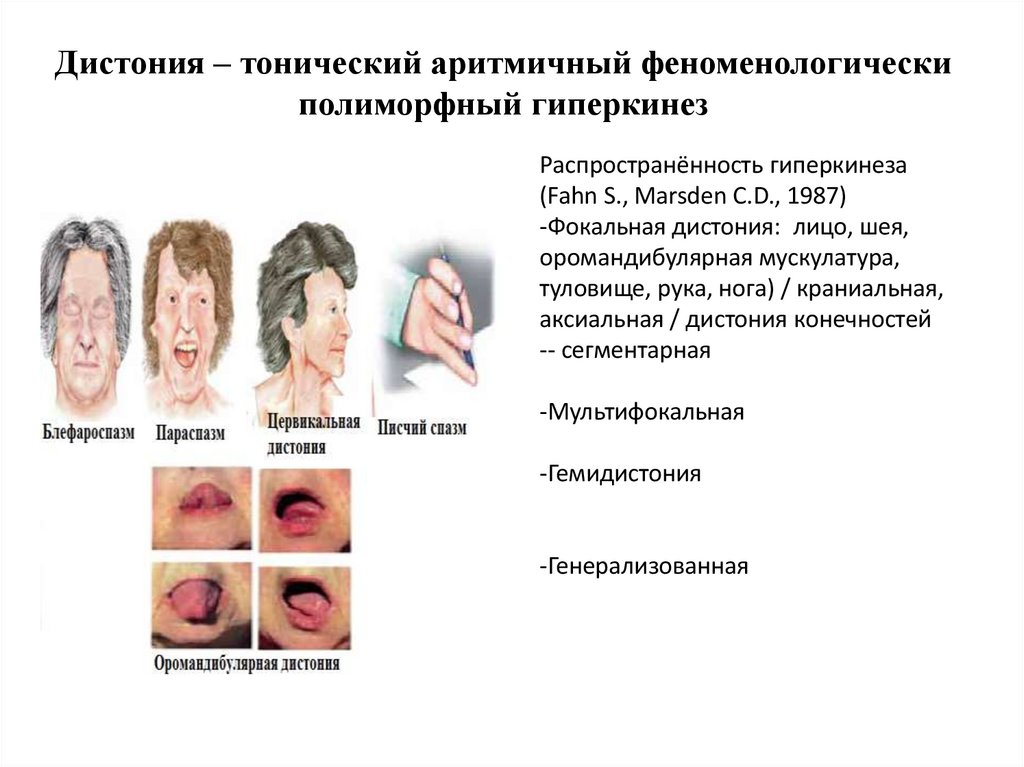 Дистония – тонический аритмичный феноменологически полиморфный гиперкинез