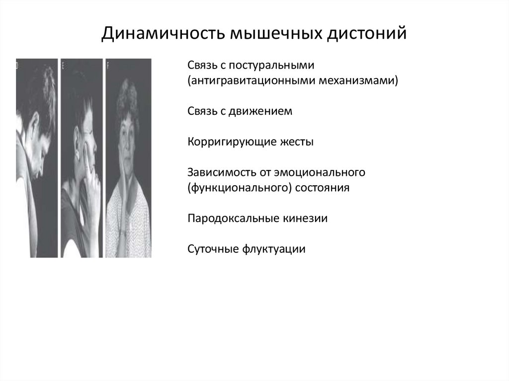 Динамичность мышечных дистоний