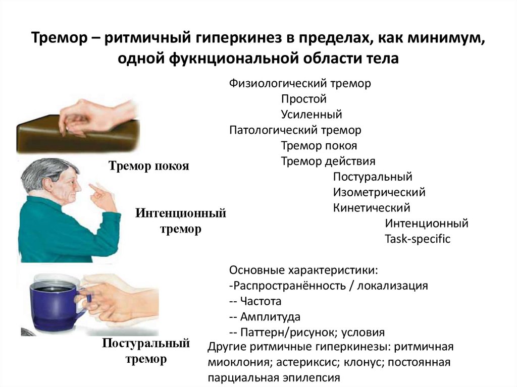Тремор – ритмичный гиперкинез в пределах, как минимум, одной фукнциональной области тела