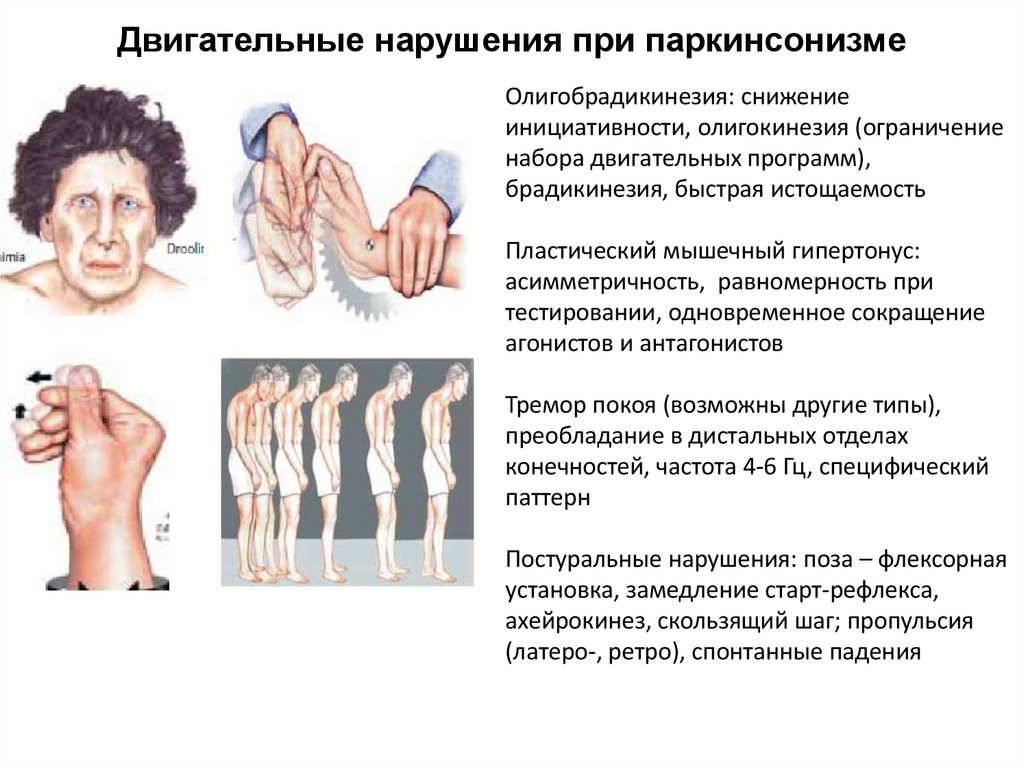 Двигательные нарушения при паркинсонизме