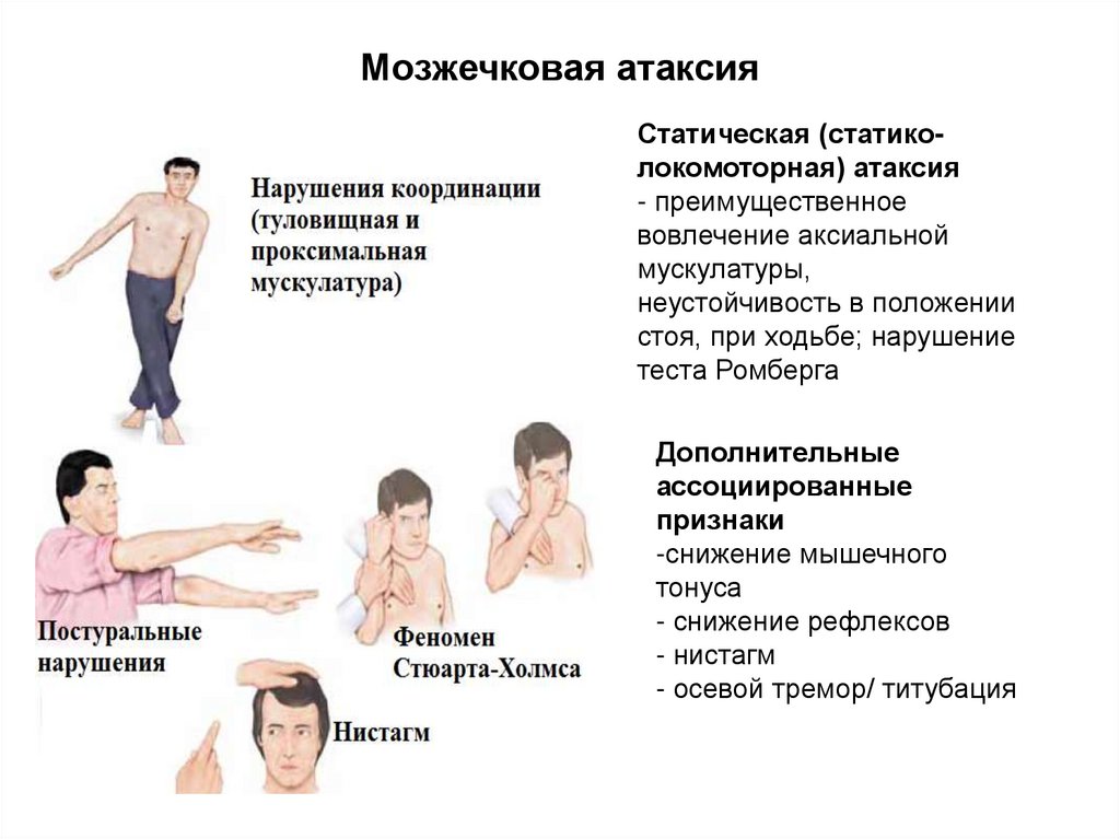 Мозжечковая атаксия