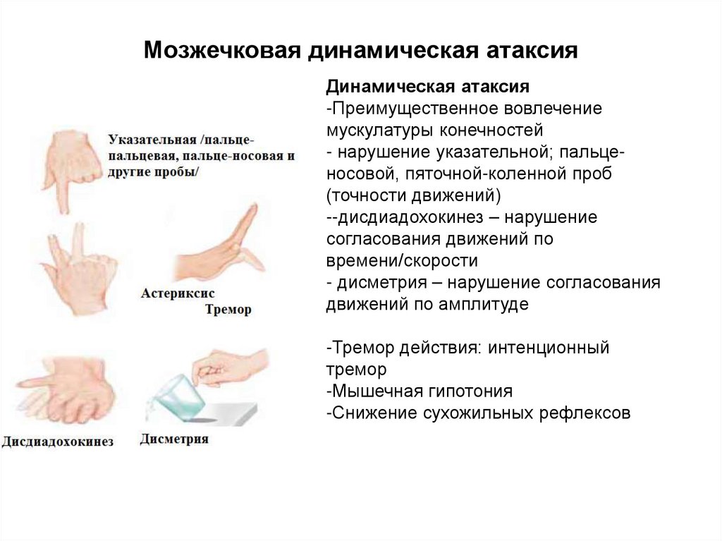 Мозжечковая динамическая атаксия