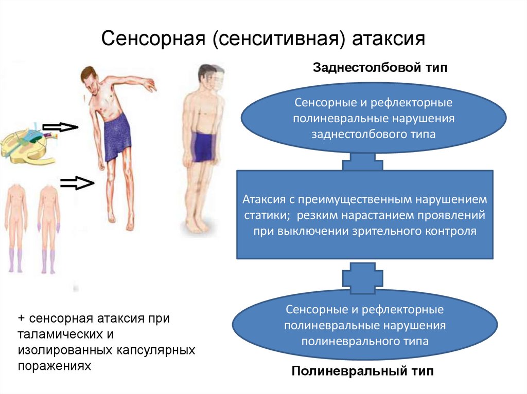 Сенсорная (сенситивная) атаксия