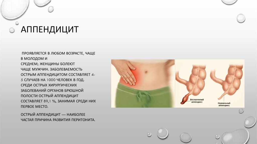 Аппендицит