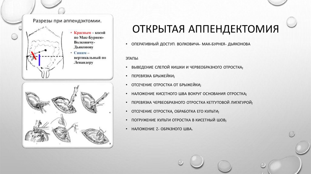 Открытая аппендектомия