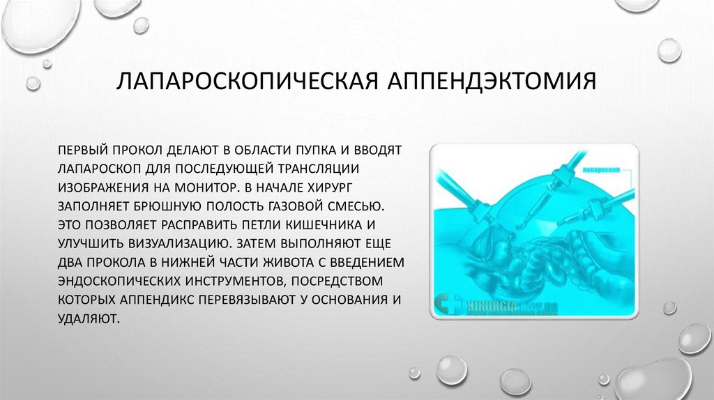 Лапароскопическая аппендэктомия