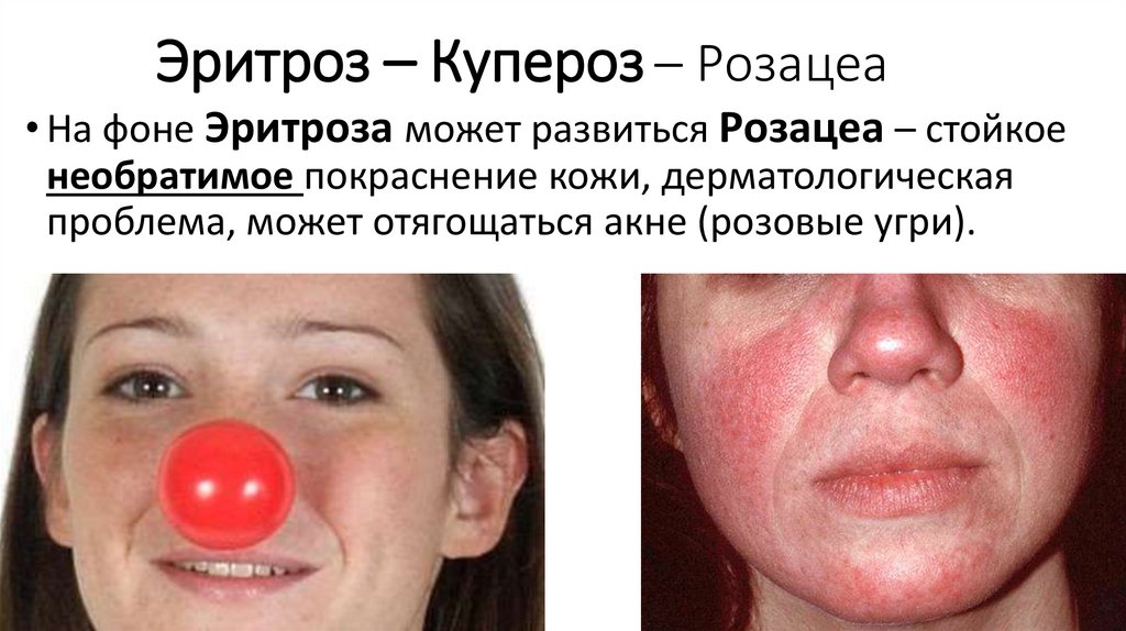 Эритроз – Купероз – Розацеа