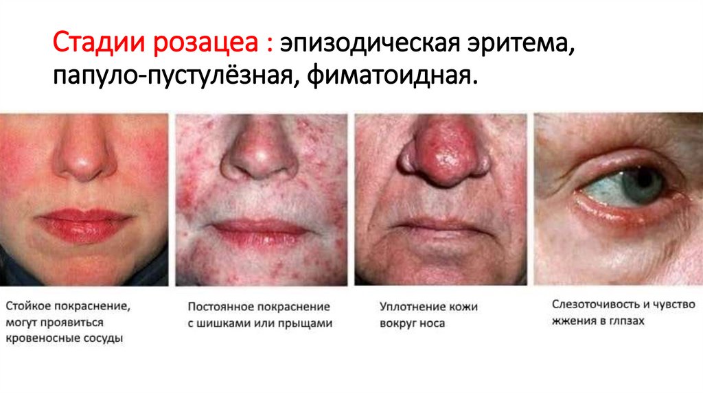 Стадии розацеа : эпизодическая эритема, папуло-пустулёзная, фиматоидная.