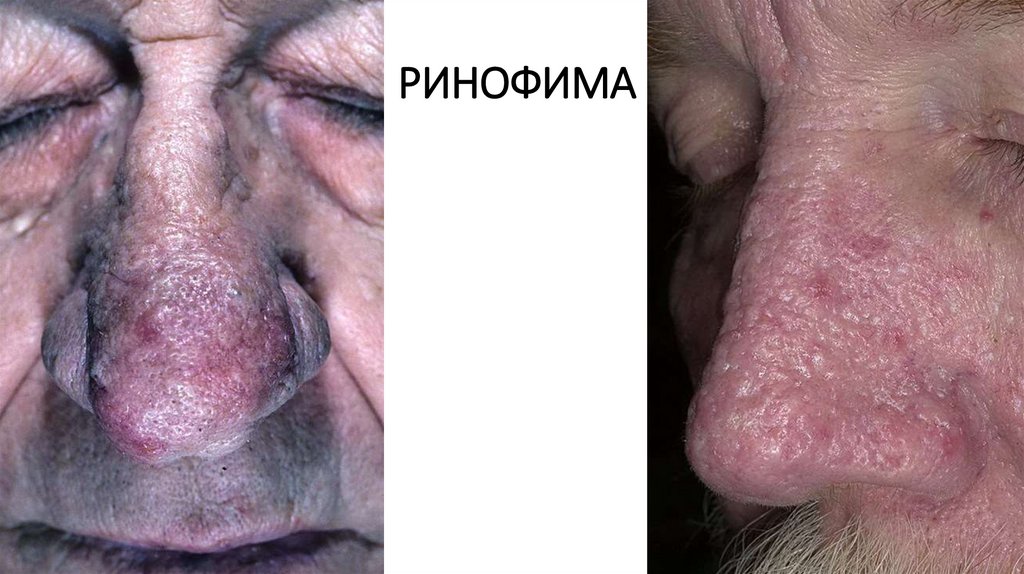 РИНОФИМА