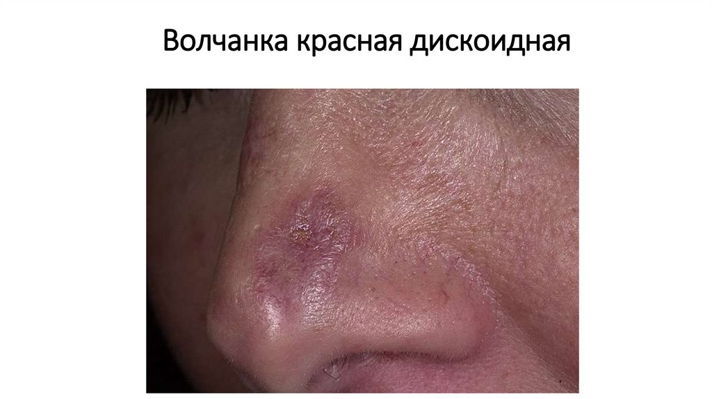 Волчанка красная дискоидная