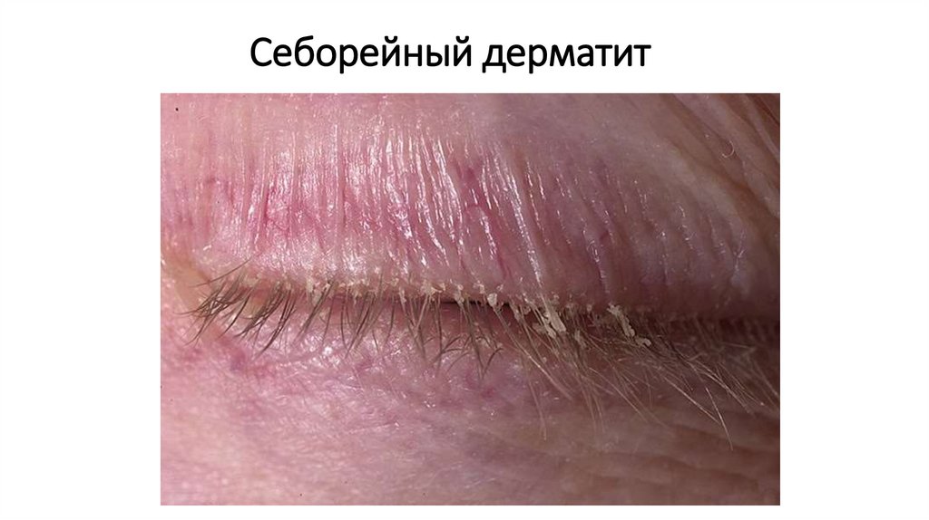 Себорейный дерматит
