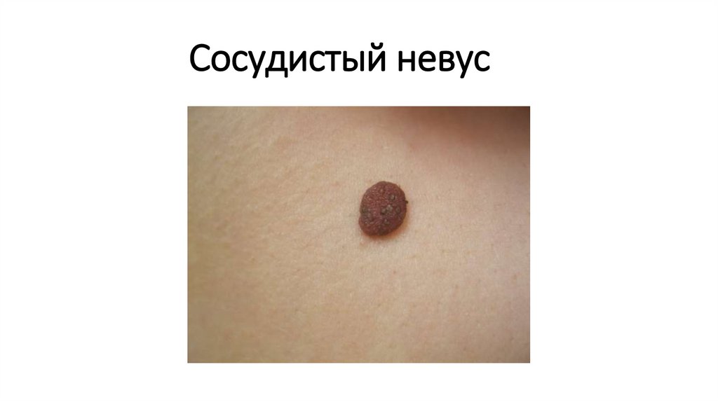 Сосудистый невус