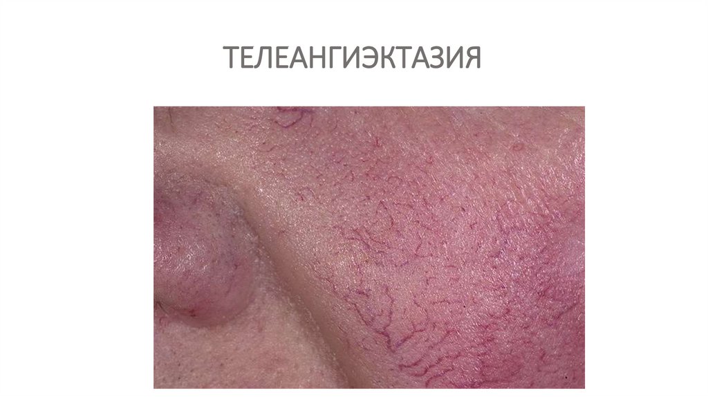 ТЕЛЕАНГИЭКТАЗИЯ