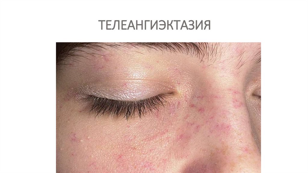 ТЕЛЕАНГИЭКТАЗИЯ
