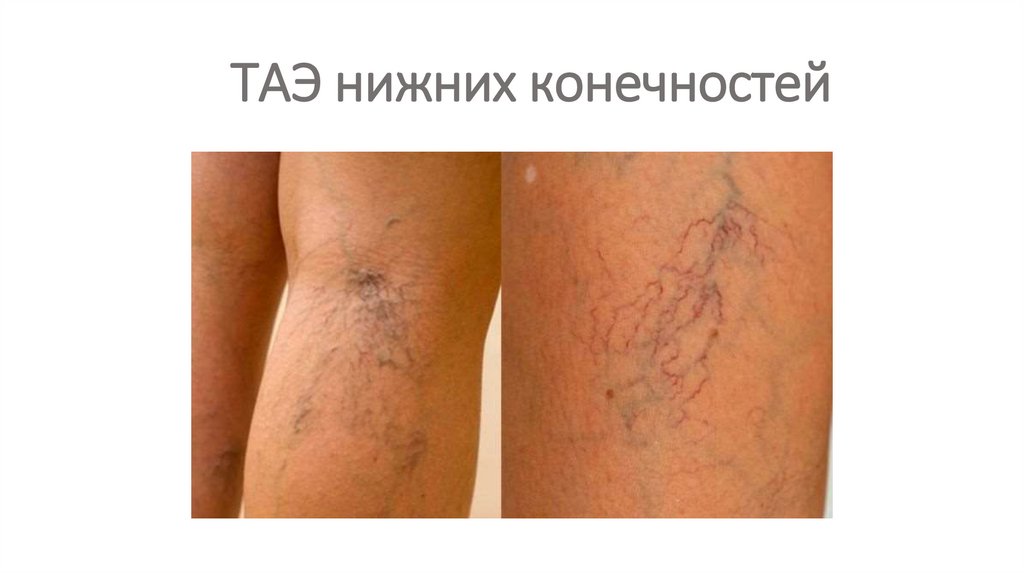 ТАЭ нижних конечностей