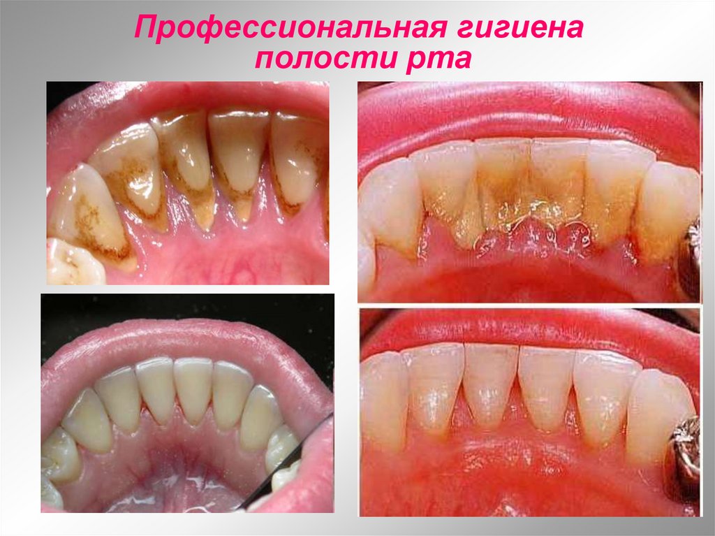 Профессиональная гигиена полости рта