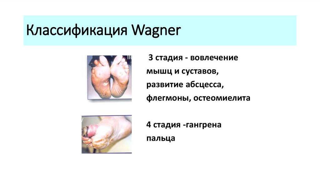 Классификация Wagner