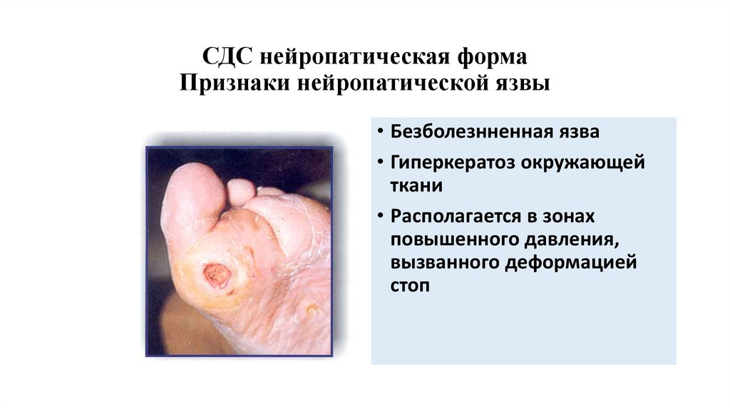 СДС нейропатическая форма Признаки нейропатической язвы