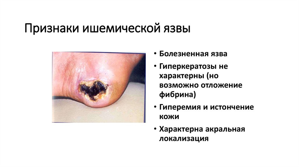 Признаки ишемической язвы