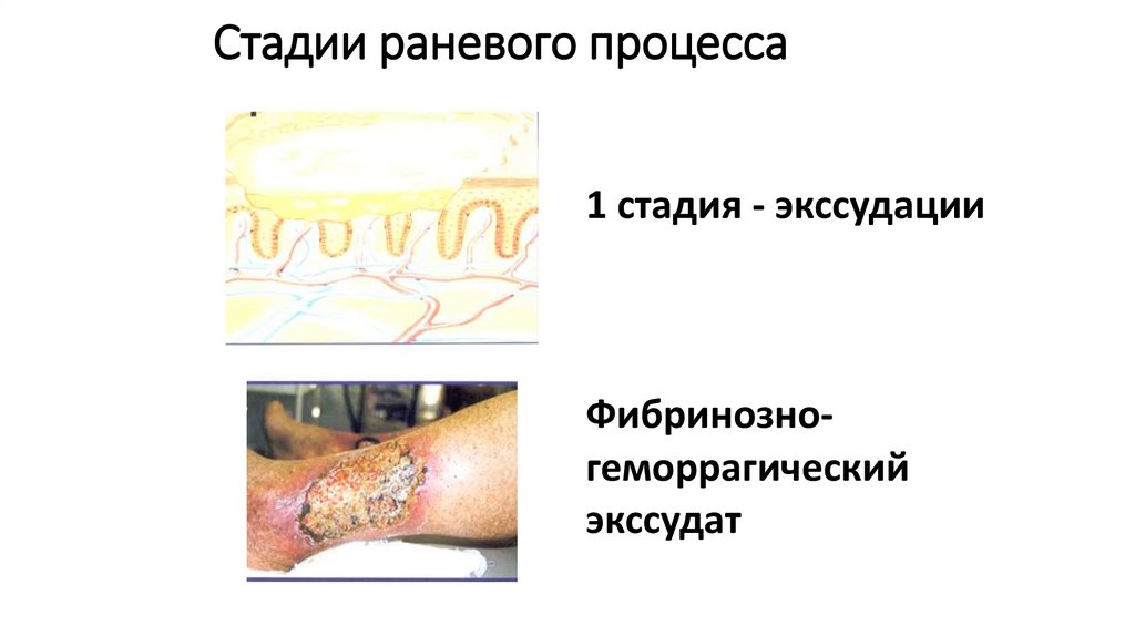 Стадии раневого процесса