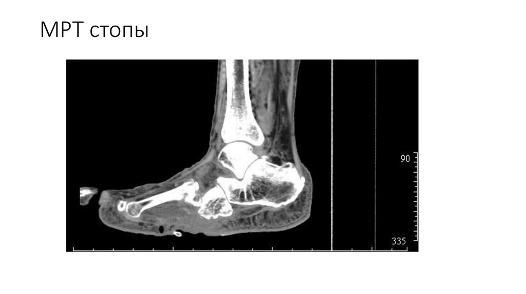 МРТ стопы