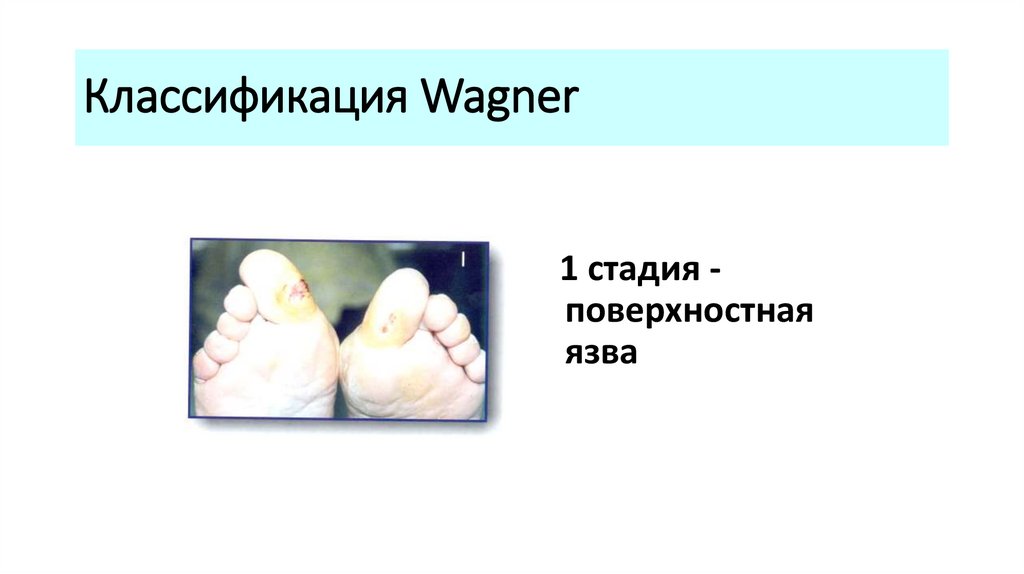 Классификация Wagner